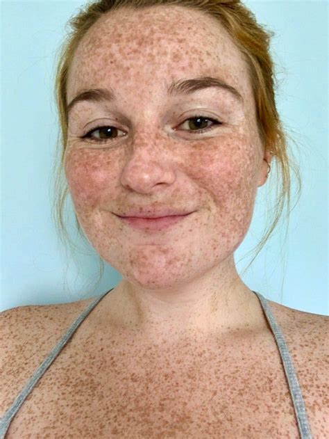 freckles bikini